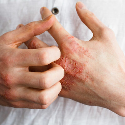 4 Cities That Are Unlivable for Eczema Patients