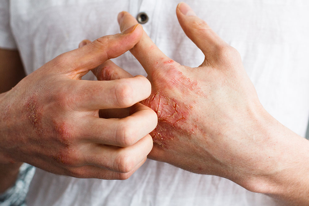 4 Cities That Are Unlivable for Eczema Patients