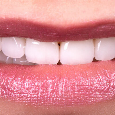 Natural Teeth Whitening – Myths vs. Reality