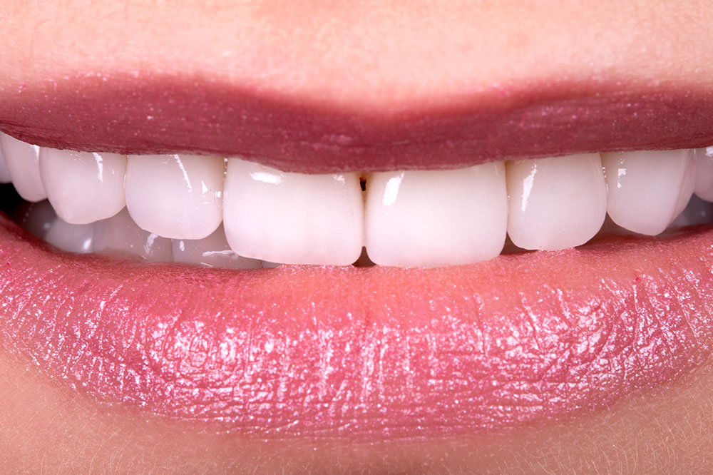 Natural Teeth Whitening – Myths vs. Reality